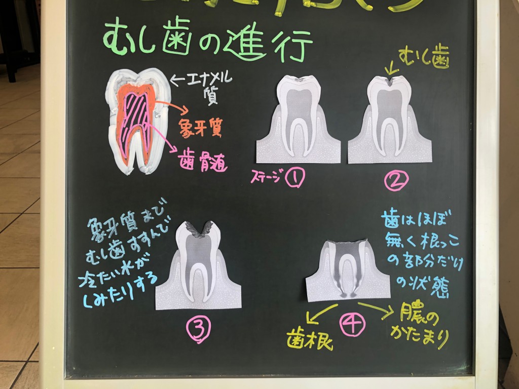 歯医者の一言（虫歯の進行）
