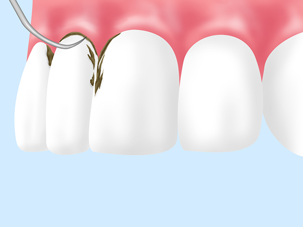 スケーリング（歯ぐきより上の歯石除去）