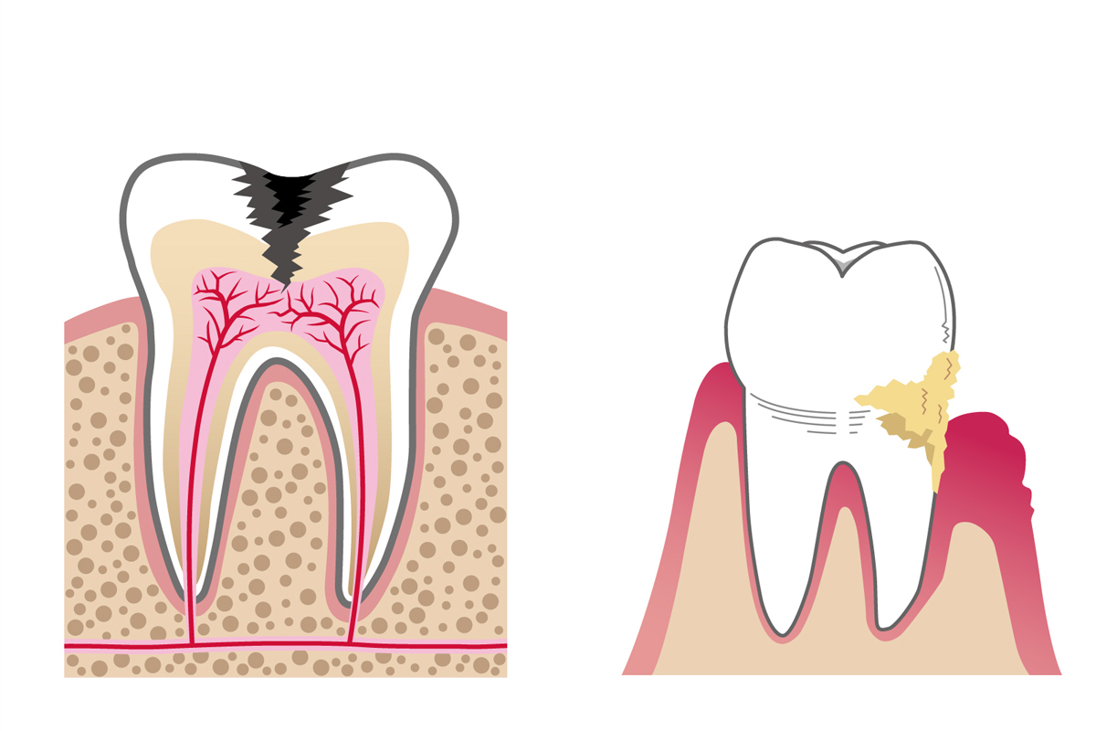 歯を失う原因の7割は「虫歯」と「歯周病」
