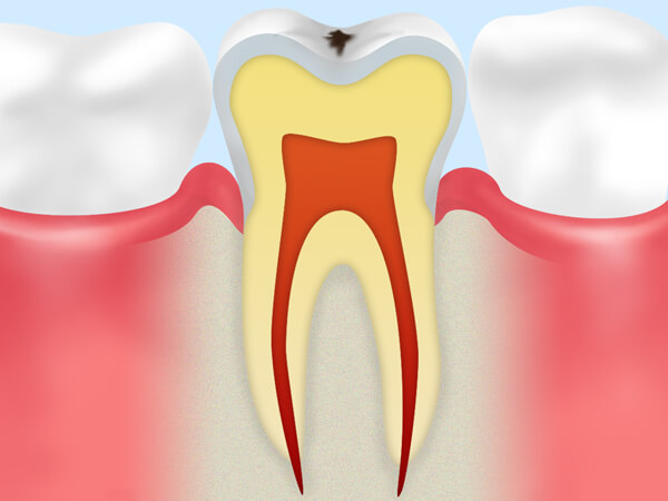 初期虫歯（CO）