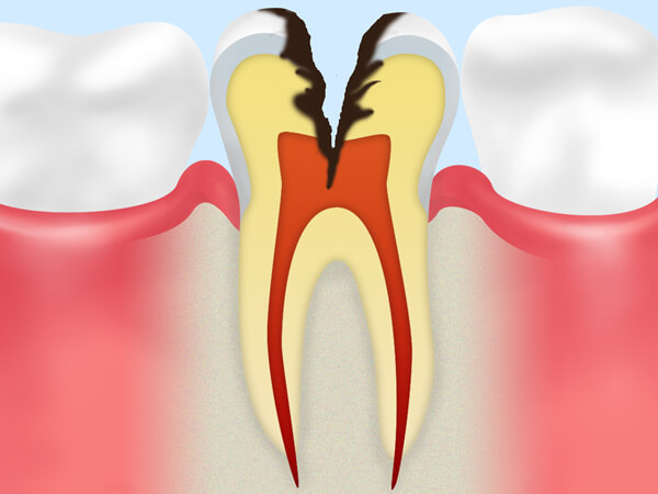 歯髄（歯の神経）に達した虫歯（C3）