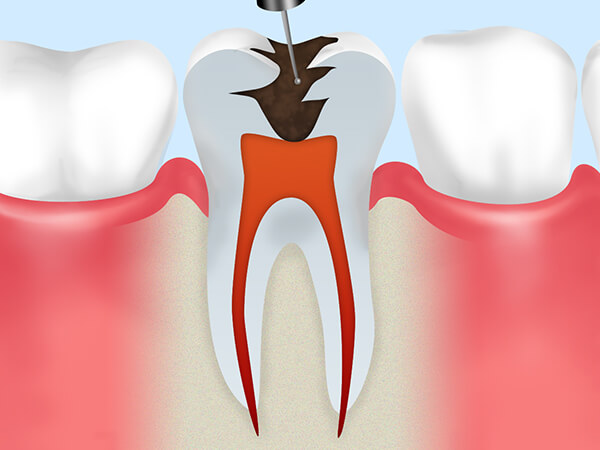 虫歯が歯の神経にまで達したケース