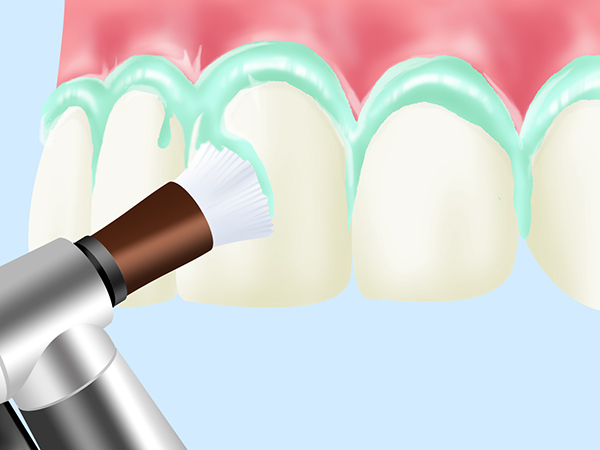 PMTC（歯の表面のクリーニング）